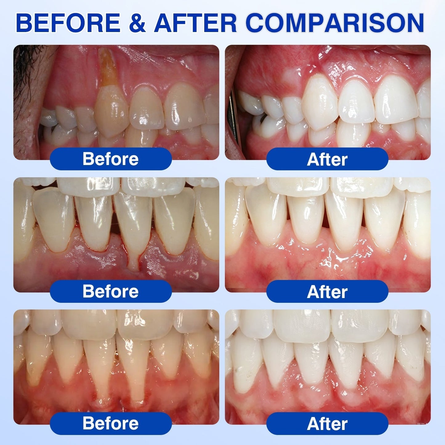 🇨🇦🦷Curalona® GumRevive Periodontal Repair Gel (For Bleeding Gums, Gum Recession & Loose Teeth)