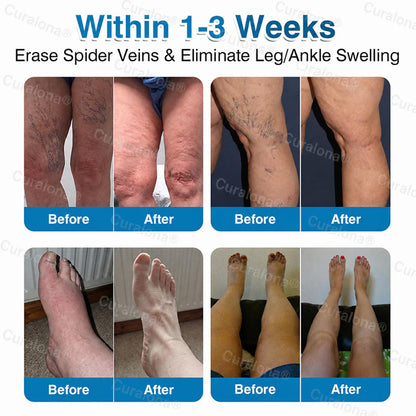 🇨🇦🏆✅️🏃Curalona® VeinRepair Microneedle Patch Roll⚡Instant Relief, Long-Term Results