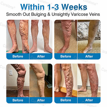 🇨🇦🏆✅️🏃Curalona® VeinRepair Microneedle Patch Roll⚡Instant Relief, Long-Term Results