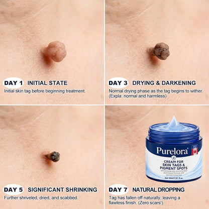 𝐏𝐔𝐑𝐄𝐋𝐎𝐑𝐀® 𝟕-𝐃𝐚𝐲 𝐒𝐤𝐢𝐧 𝐓𝐚𝐠 & 𝐒𝐩𝐨𝐭 𝐑𝐞𝐦𝐨𝐯𝐚𝐥 𝐂𝐫𝐞𝐚𝐦 (𝐏𝐚𝐢𝐧𝐥𝐞𝐬𝐬 𝐅𝐨𝐫𝐦𝐮𝐥𝐚 – 𝐍𝐨 𝐒𝐜𝐚𝐫𝐫𝐢𝐧𝐠) 🌹🌹