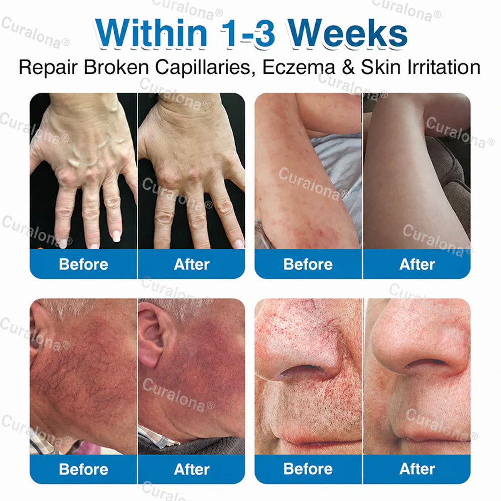🇨🇦🏆✅️🏃Curalona® VeinRepair Microneedle Patch Roll⚡Instant Relief, Long-Term Results
